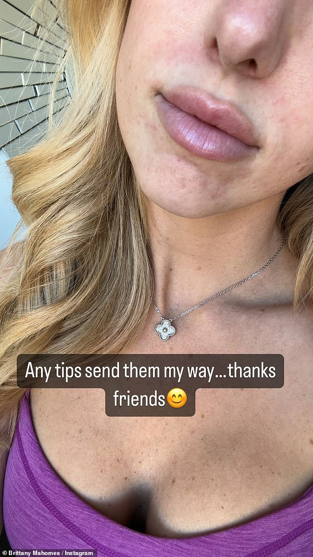 Die 28-jährige ehemalige Sportlerin nutzte Instagram Stories, um ihren fast zwei Millionen Followern einen „Realitätscheck“ über ihre Probleme mit Akne zu geben