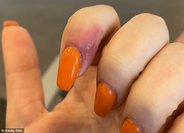 Das obige Bild, das von der 23-jährigen Frau in Oregon geteilt wurde, zeigt den Herpes an einem ihrer Finger