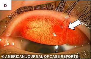 Durch den Hundebiss platzten Blutgefäße in den Augen des Patienten, was zu einer Blutung führte