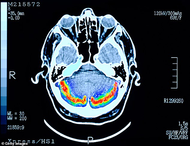 LEBENSVERÄNDERUNG: Ein Gehirnscan eines Patienten mit Demenz im Frühstadium