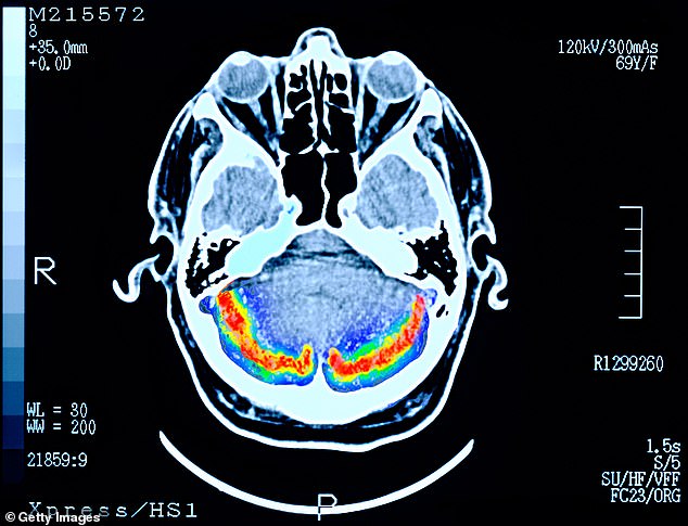 LEBENSVERÄNDERUNG: Ein Gehirnscan eines Patienten mit Demenz im Frühstadium