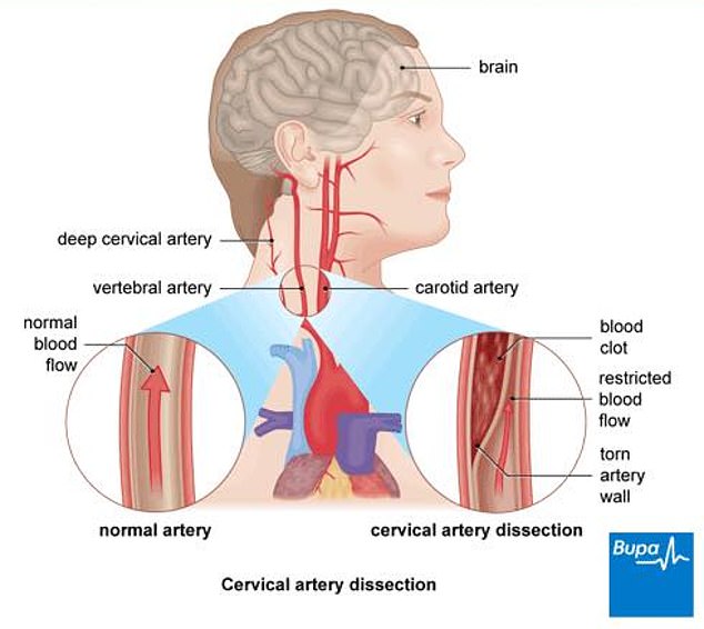 Durch den Riss gelangt Blut zwischen die Schichten der Arterienwand und trennt diese.  Dadurch wölbt sich die Arterienwand, was den Blutfluss zum Gehirn verlangsamen oder stoppen kann.  Dies kann zu einer transitorischen ischämischen Attacke (TIA) oder einem Schlaganfall führen