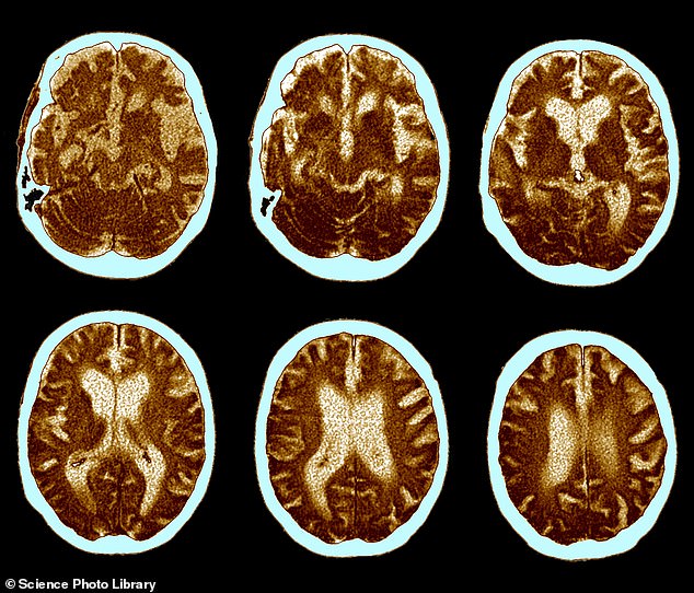 Über 100 Jahre durchgeführte MRTs zeigten, dass die Gehirngröße um 6,6 Prozent zugenommen hat und das Risiko, an Alzheimer zu erkranken, für jüngere Generationen verringern könnte