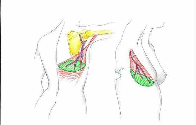 Explanatory diagram of the latissimus dorsi flap for breast reconstruction. 