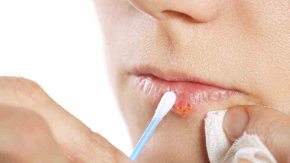 You should use a cotton swab to treat cold sores