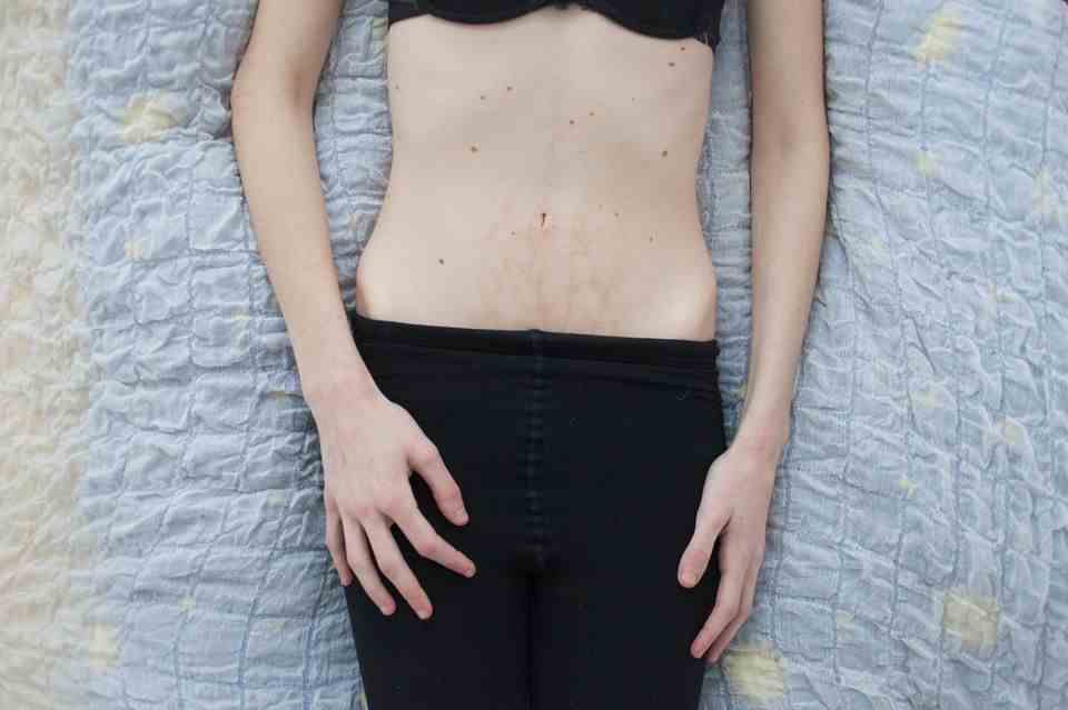 Linda has been affected by anorexia (anorexia) and bulimia for years