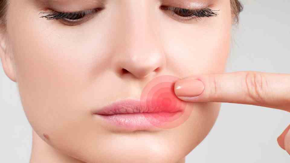 What helps against herpes?