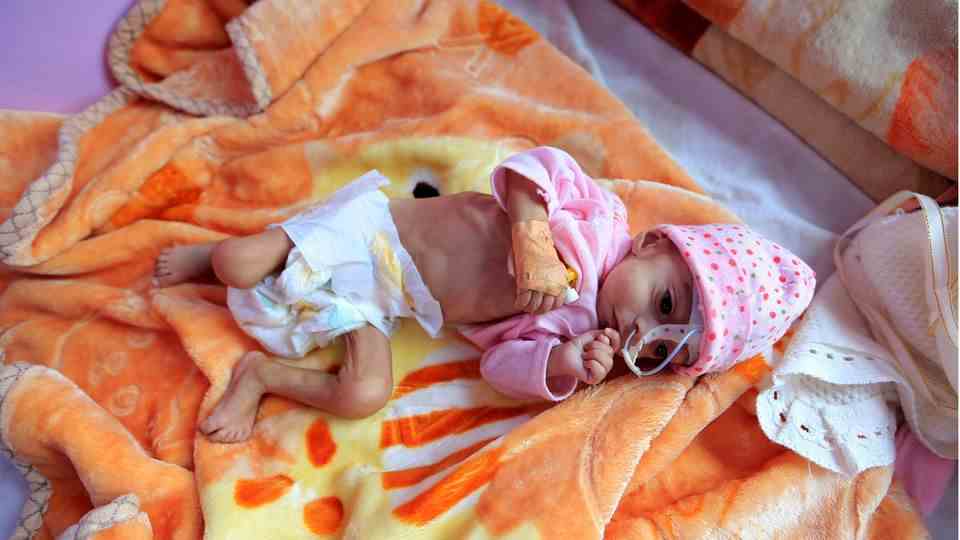 Sanaa, Yemen.  A baby lies in a hospital in the Yemeni capital.  Severe famine is raging in Yemen, aggravated by the war in Ukraine.  The population suffers from malnutrition, especially the children.
