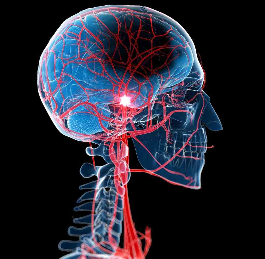 A stroke occurs when certain areas of the brain are no longer properly supplied with blood due to a vascular occlusion