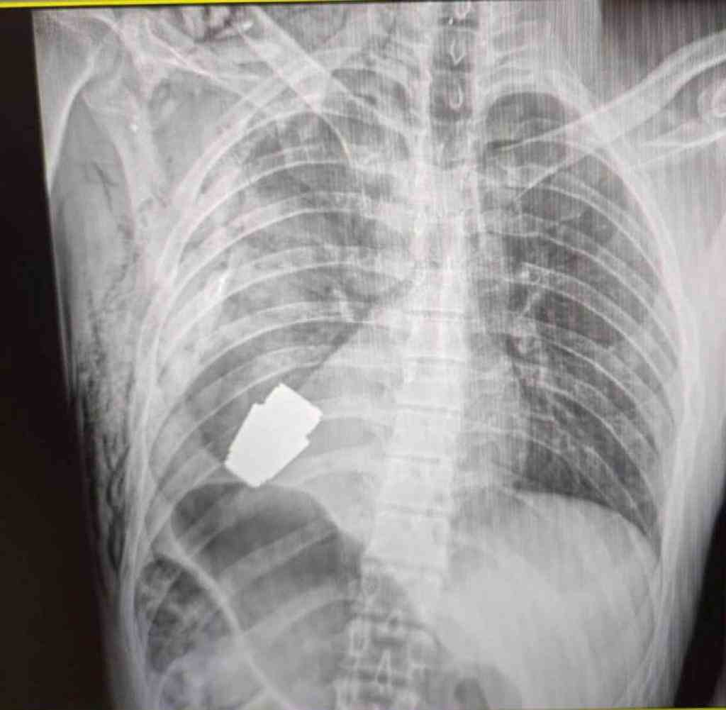 Ein Chirurg konnte die VOG-Granate erfolgreich aus dem Brustkorb des ukrainischen Soldaten entfernen. Der Zustand des Mannes sei stabil (https://www.facebook.com/ganna.maliar )