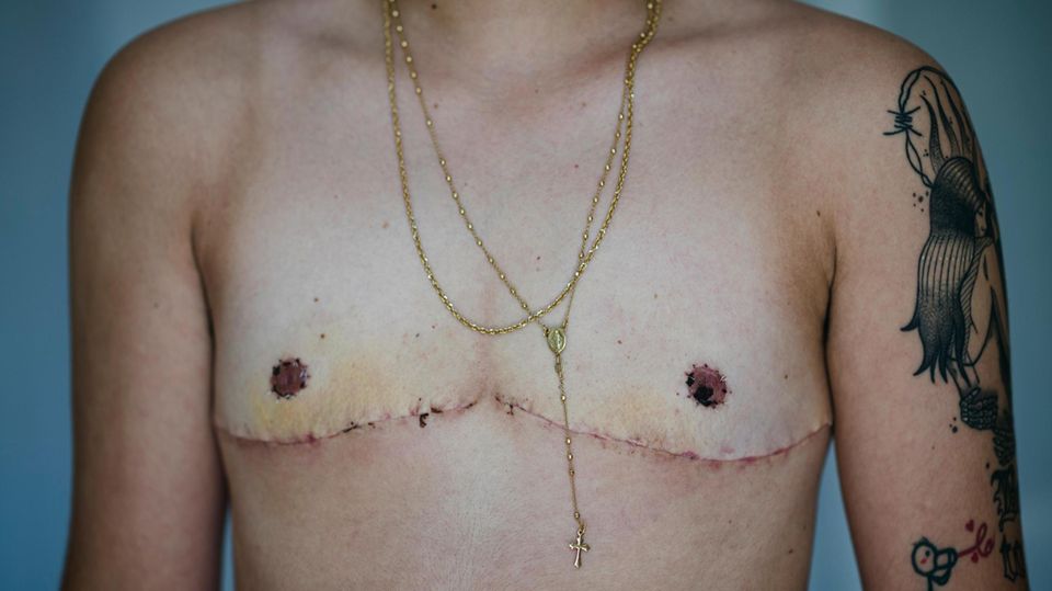 Photo of a removed breast