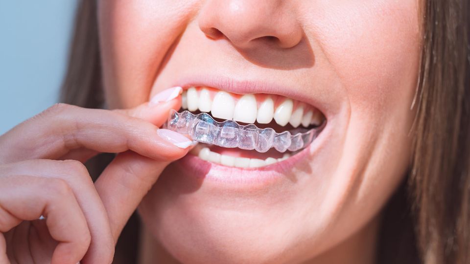 Adult braces: A woman inserts an aligner