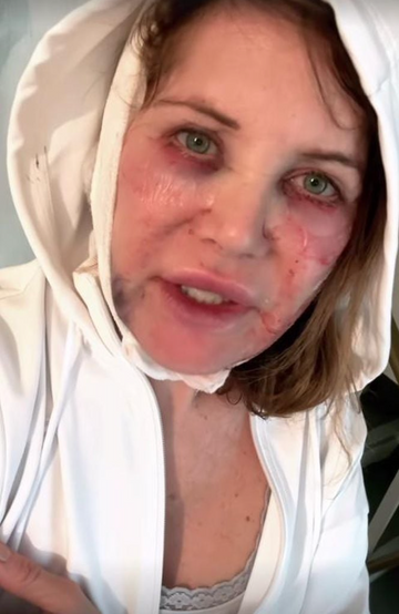 Doreen Dietel shows up on Instagram after a beauty procedure.