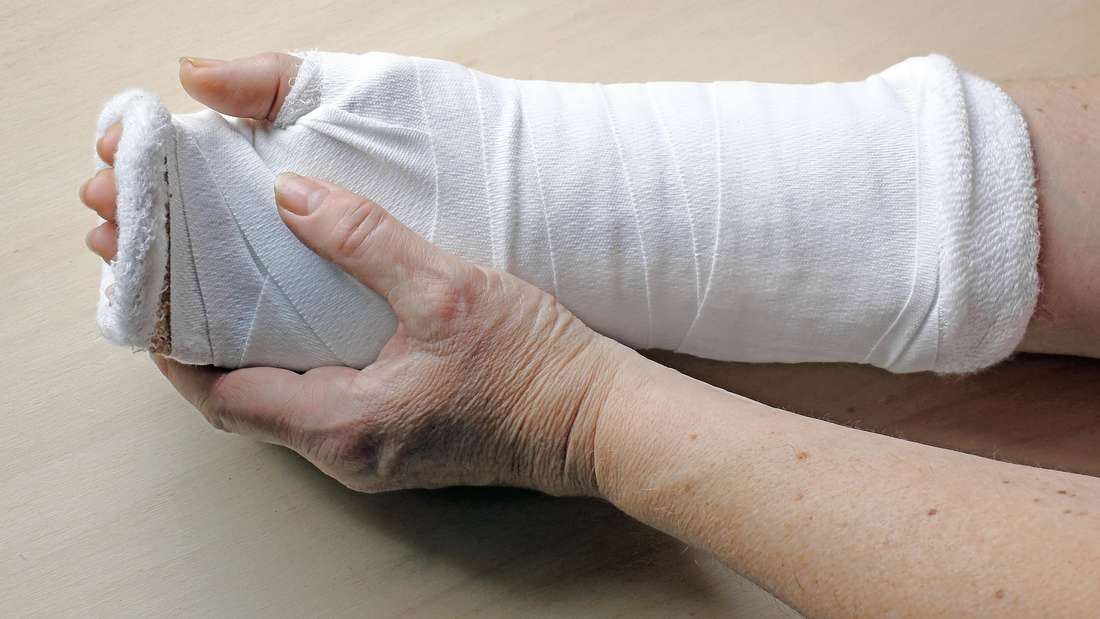 Woman with a cast on her arm