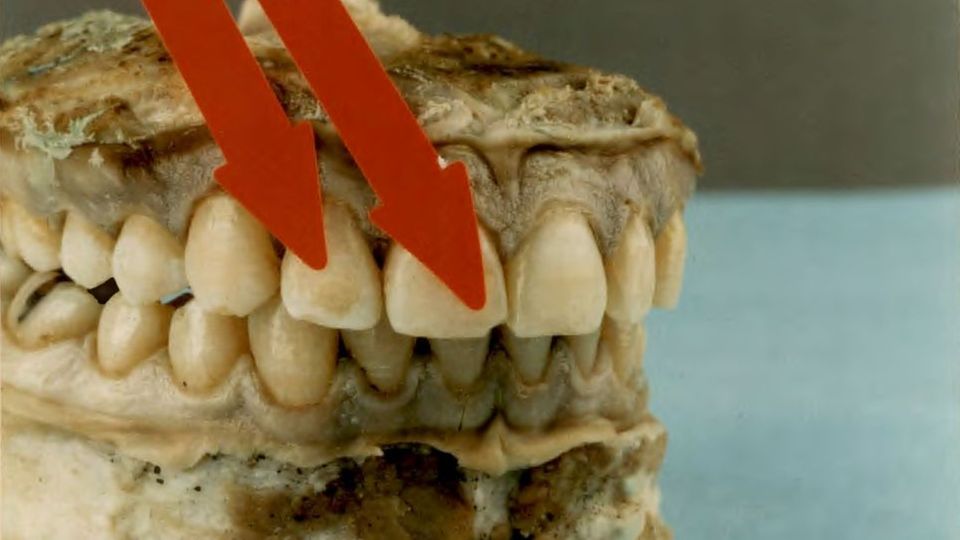 The teeth of the victim from Hagen