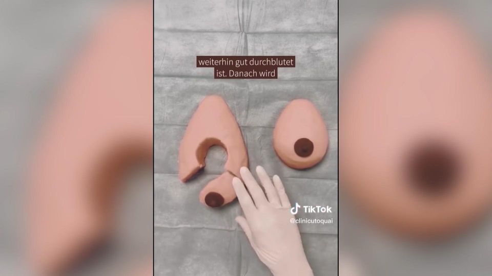 Tik Tok video: Surgeon educates millions about breast reductions