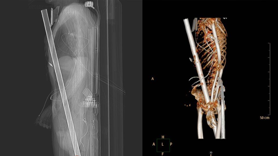 Published images from the clinic show the fence pole in the patient's body