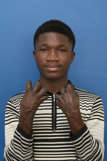 VfBB club: The fingers are much thicker than healthy ones and have no fingernails, but after numerous operations Sule can do almost everything with his hands again.