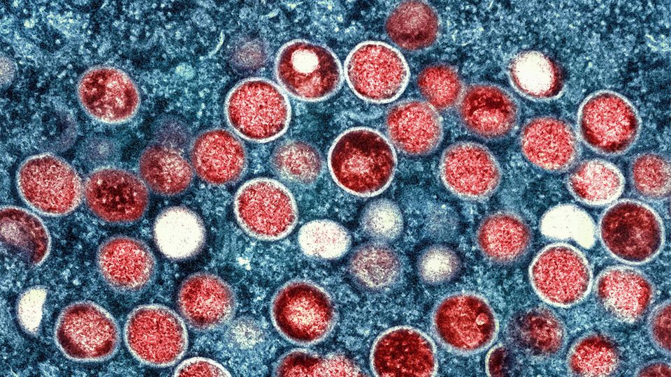 A colorized transmission electron micrograph of monkeypox virus particles