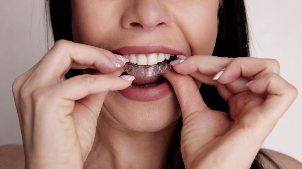 Treatment with aligners: A woman inserts a clear dental aligner