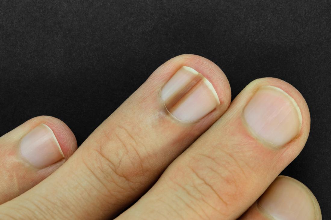 Discoloration skin cancer fingernail health