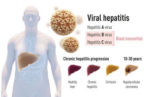 Graphical representation of the characteristics and consequences of hepatitis A, B and C
