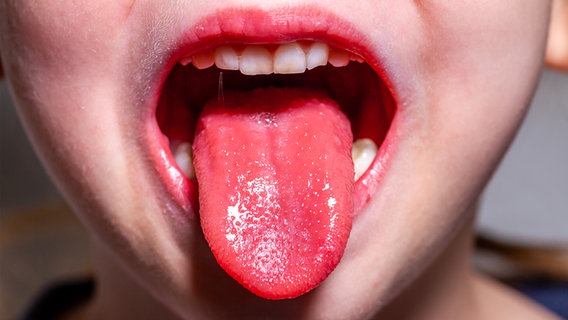 Ein Kind streckt eine rote Zunge heraus. © Panthermedia Foto: Lukassek