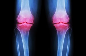 X-ray image of inflamed knees
