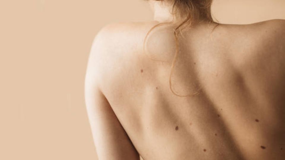 Skin cancer: The picture shows a woman's back with birthmarks