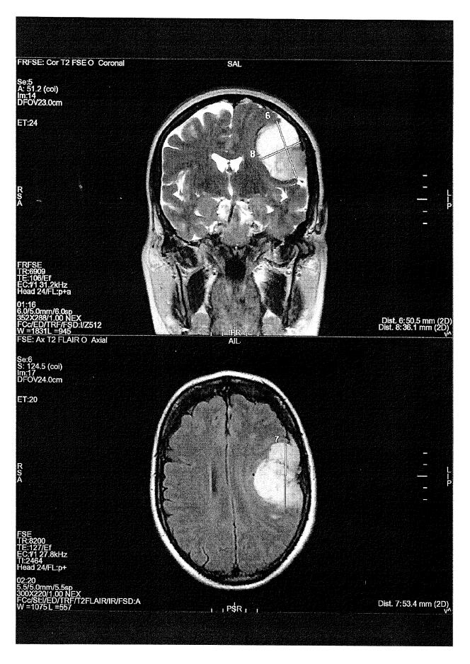 Magnetic resonance imaging (MRI) showing a meningioma caused in a victim by taking Androcur, or other progestins.